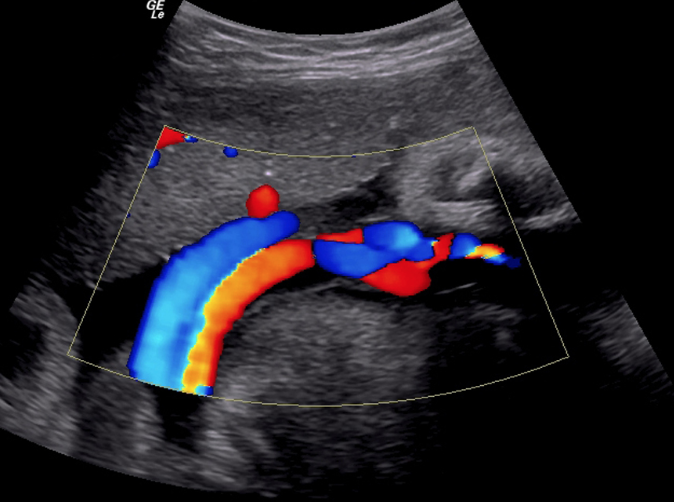 Enfermedad carotídea: cómo se diagnostica y cuál es su tratamiento