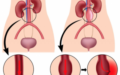 Aneurisma de aorta abdominal: qué es y cuál es su diagnóstico