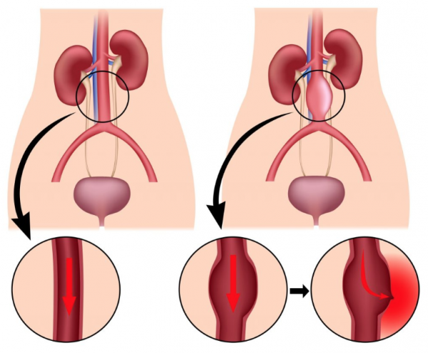 Aneurisma de aorta abdominal: qué es y cuál es su diagnóstico
