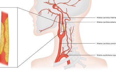 Estenosis carotídea posterior a radioterapia operada con exito por nuestra Unidad