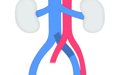 La Unidad de Patología Vascular publica en la revista “Angiología” de la Sociedad Española de Angiología y Cirugía Vascular los Consejos en el tratamiento endovascular del síndrome de May-Thurner