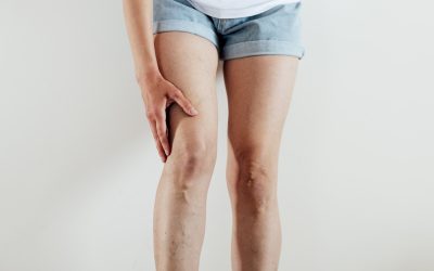 La salud venosa, un factor determinante en la prevención de las varices