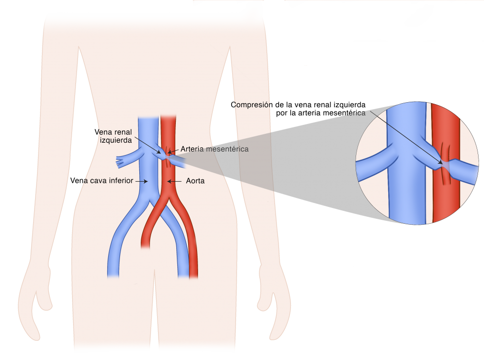 Síndrome de Nutcracker Unidad de Patología Vascular