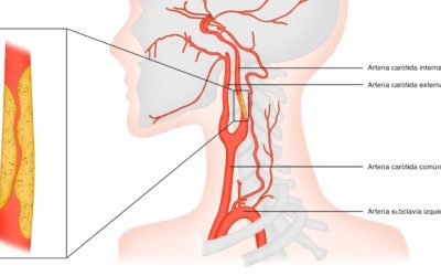 Una estenosis en las arterias carótidas puede avanzar sin síntomas hasta provocar un ictus