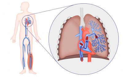 Procedimientos innovadores para el tromboembolismo pulmonar