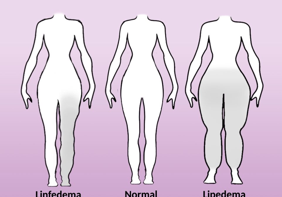 Lipedema y linfedema, dos enfermedades con síntomas parecidos, pero tratamientos distintos