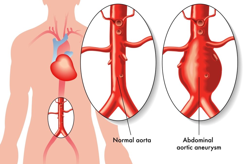 Aneurisma de aorta abdominal